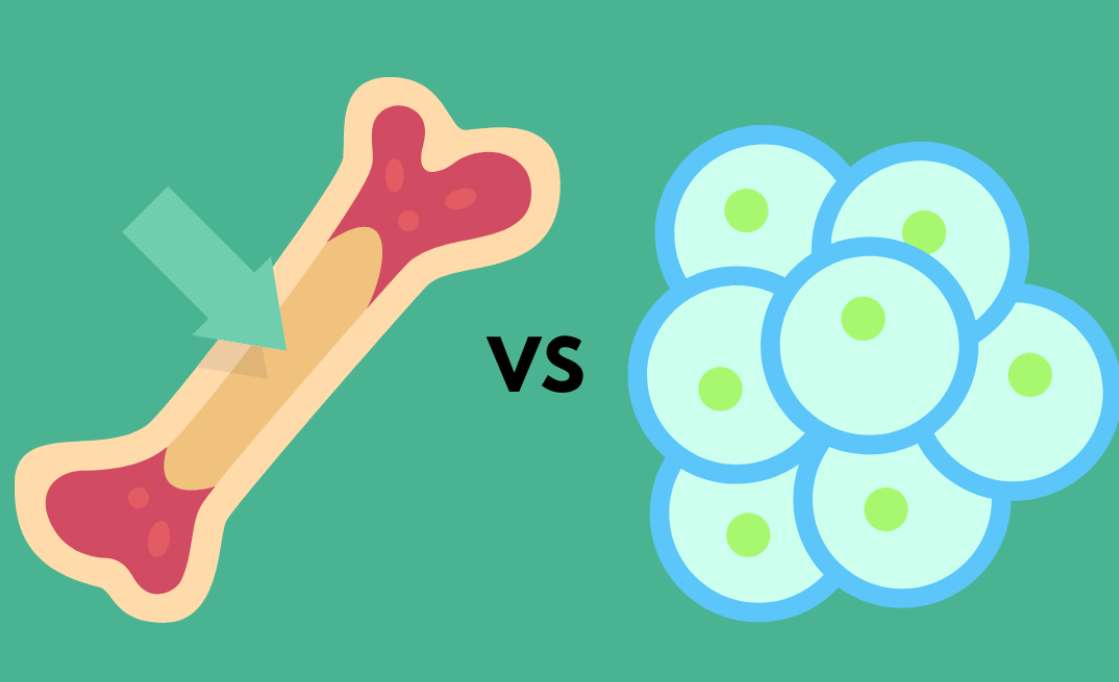 Cord Blood vs. Bone Marrow: